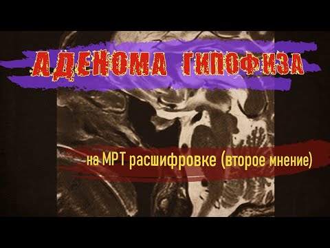 АДЕНОМА ГИПОФИЗА у мужчин на РАСШИФРОВКЕ МРТ гипофиза с контрастом