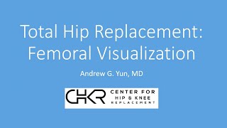 Total Hip Replacement: Femoral Visualization