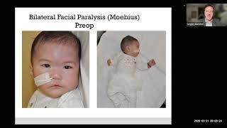 Moebius Syndrome and Bilateral Facial Paralysis