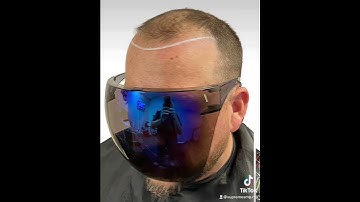 AMAZING HAIR LOSS SOLUTION!!!INCREDIBLE TRANSFORMATIONS!!! @supremesmp2047