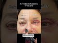 LOWER EYE-LID RETRACTION REPAIR | 1 WEEK POST-OP
