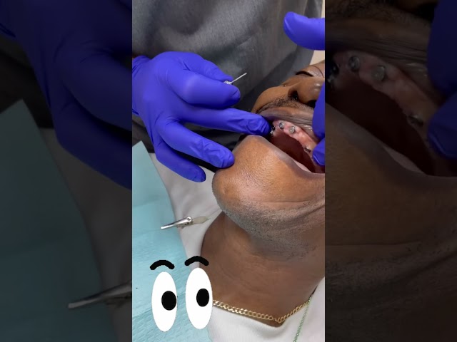 Healing Abutments Removal!
