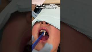 How to turn a Rapid Palatal Expander (RPE) Net Worth