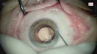 Ophthalmic surgery live 18+ Lukan Mishev