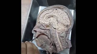 Mid sagital section of head