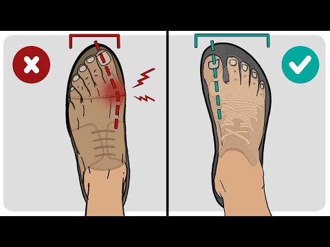 The Primary Cause of Bunions Explained