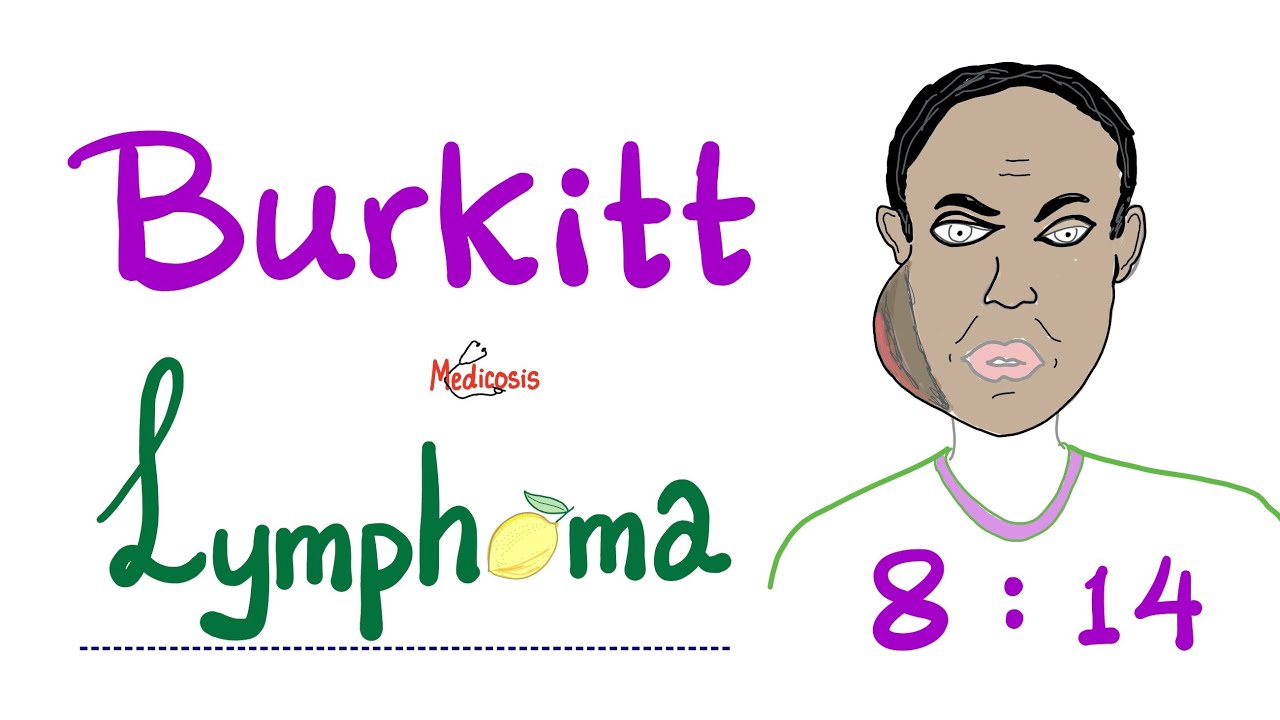 Burkitt’s Lymphoma | Aggressive B-Cell Non-Hodgkin’s Lymphoma | Fastest Growing Cancer!!