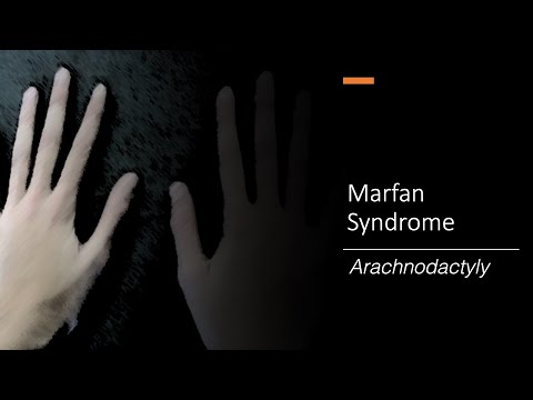 Marfan Syndrome: Wrist and Thumb Sign