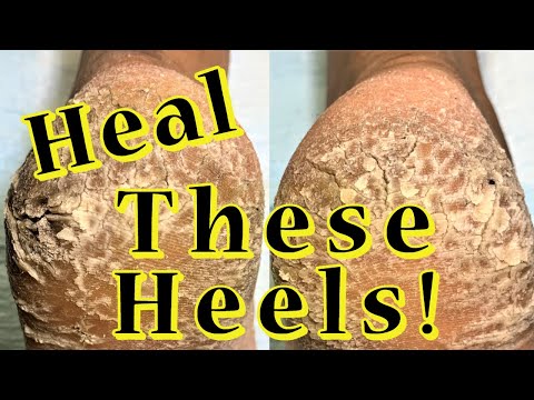 7 ways to treat cracked heels