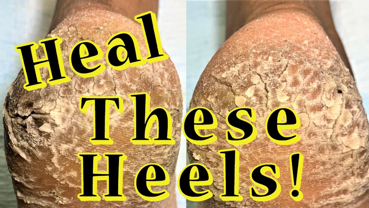 HUGE Heel Cracks + Callus Removal - YouTube