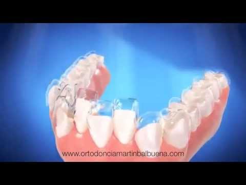 INVISALIGN ORTODONCIA INVISIBLE SEVILLA
