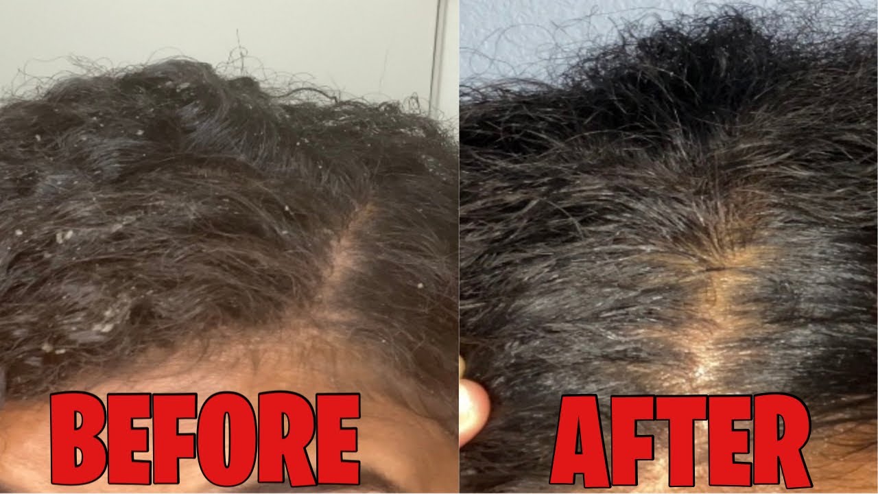 HOW TO GET RID OF DRY SCALP/ DANDRUFF ON CURLY HAIR - YouTube