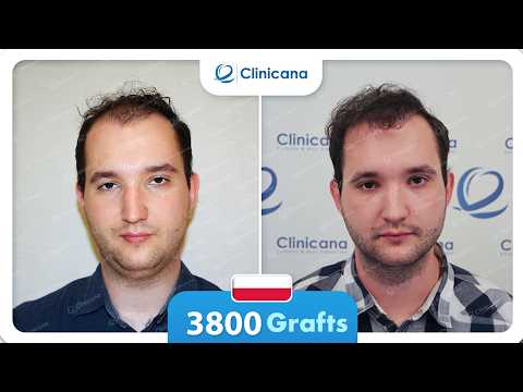 Adrian’s hair transplant