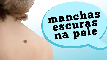 ¿Puede el melanoma ser benigno?