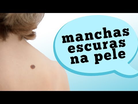 Vídeo: O que é manchas marrons?