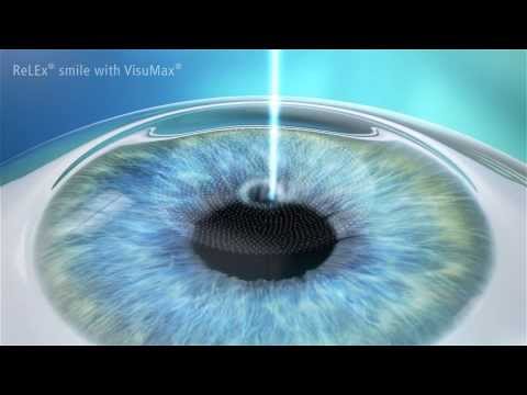 SMILE-Methode - Sicheres und minimal-invasives Augenlaserverfahren