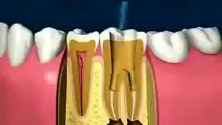 كيفية حشو قنوات الأسنان بالتفصيل Comment obturer les canaux dentaires
