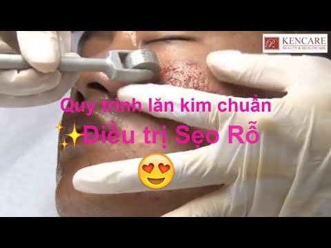 Phương pháp lăn kim tế bào gốc điều trị Sẹo rỗ | Quy trình lăn kim chuẩn của Bác sĩ
