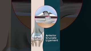 What is an ACL TEAR?