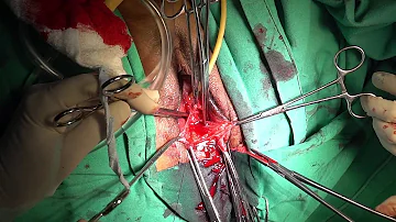 O que é perineoplastia anterior e posterior?