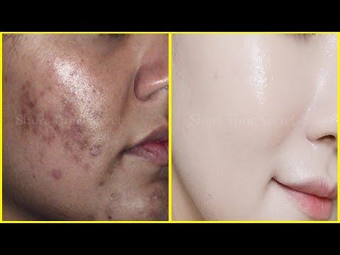How to Remove BLACK SPOTS , DARK SPOTS & ACNE SCARS on face | ONLY in  days | % Spotless Skin