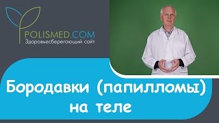 Бородавки (папилломы) на теле: на руках, на ногах, на носу, на веке, во рту, на спине(, 2015-11-30T08:13:52.000Z)