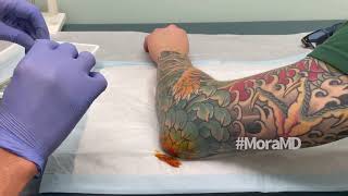 A PAINLESS Elbow Aspiration on UFC FIGHTER