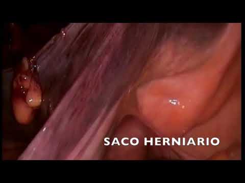 HERNIA LAPAROSCOPICA TAPP camera iphone 8 plus apk