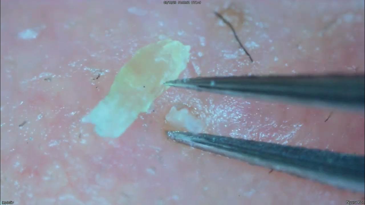 0173 keratin plug removal nose YouTube