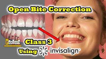 Class 3 Open Bite Correction using Invisalign and Jaw Surgery