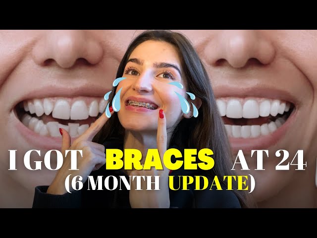 THIS IS HOW LIFE LOOKS LIKE WHEN HAVING BRACES | 6 MONTH UPDATE class=