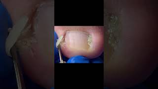 Inflamed ingrown toenail, carefully remove #satisfying #pedicure