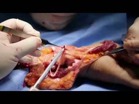 Forearm replantation