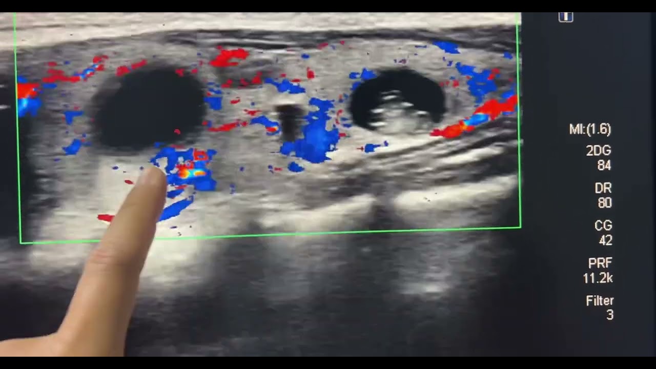 ជំងឺពកក ដោយសារដុំសាច់ និងដុំគីស | Goitre multi-nodulaire