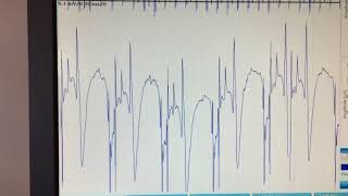 complex repetitive discharge
