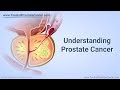 Understanding Prostate Cancer