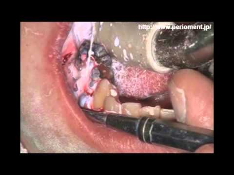 レーザー歯周病治療 Sai Oral Clinic Youtube レーザー歯周病治療 Sai Oral Clinic Youtube