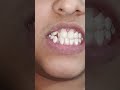 Teeth stains || #youtubeshorts #ytshorts