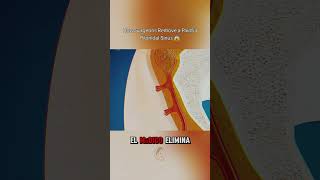 How Surgeons Remove a Painful Pilonidal Sinus 😱#shorts