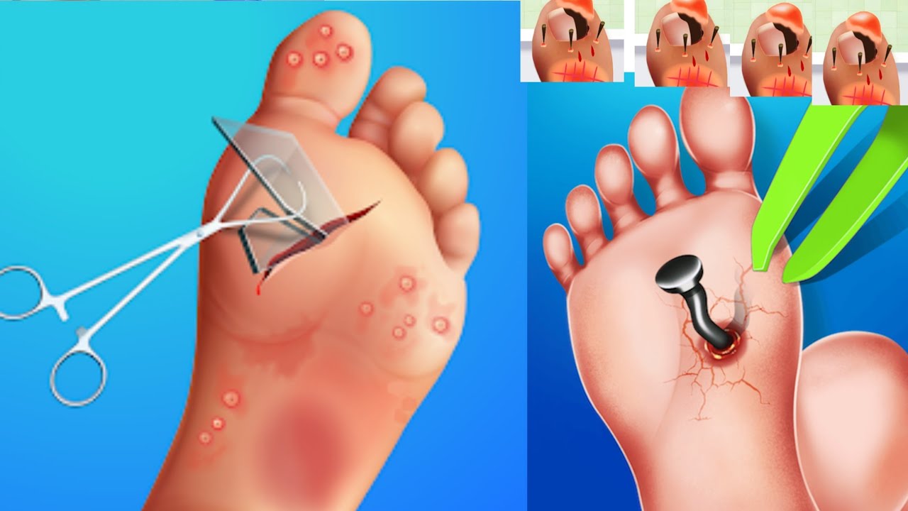 ASMR Treatment maggots from soles of feet & Remove tha pie YBeauty