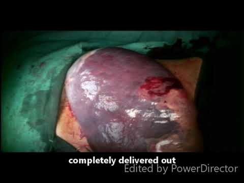 Huge splenectomy in portal hypertension by Dr DD Sharma