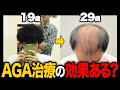 【若ハゲの希望】20代男性が薄毛治療をして6ヶ月でさらなる変化が...。