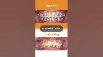 Hành trình LỘT XÁC nhờ niềng răng của Ngọc Quyên