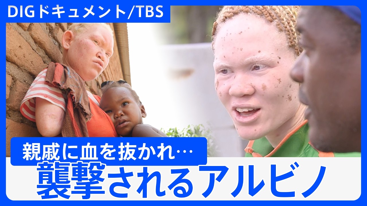 「カミソリで背中を…」呪術目的で狙われるアルビノ パリパラ五輪参加の女子選手もかつて襲われて… ザンビアに未だ残る“迷信”の実態(2020年 ...