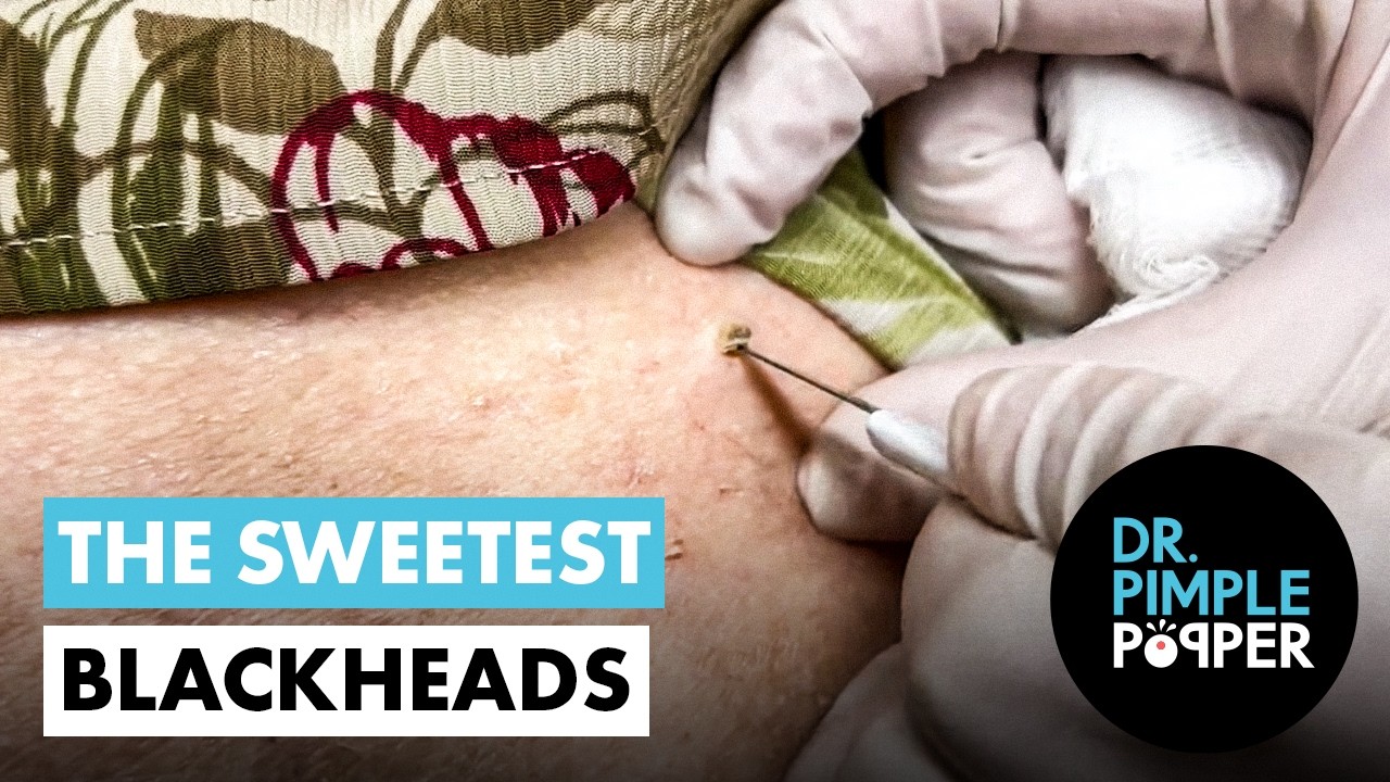 The Sweetest Blackheads