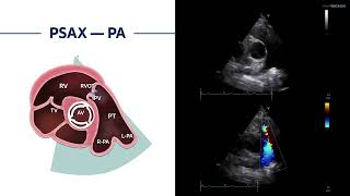 〖Echocardiography〗 PSAX - PV anatomy 🫀🏆