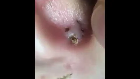 Pourquoi J Ai De La Peau Dans Les Oreilles Pourquoi J Ai De La Peau Dans Les Oreilles