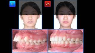 Treatment of Blocked in Upper Lateral Incisors with Excessive Overjet｜【Chris Chang Ortho】CC602