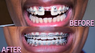 Full Braces Journey Time Lapse | 3 Years (Gaps, Overbite, Frenectomy) | Starring Shameka screenshot 4