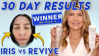 The Best At-Home Laser for Wrinkles? I Did a Side-by-Side Test | Iris vs Revive